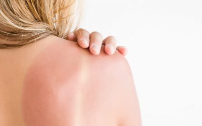 Queimaduras de sol: o que são, como evitar e melhores tratamentos