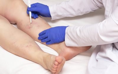 Saiba como prevenir doenças vasculares